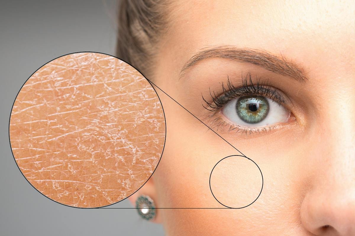 Close-up of a face with an enlarged inset showing dry skin texture