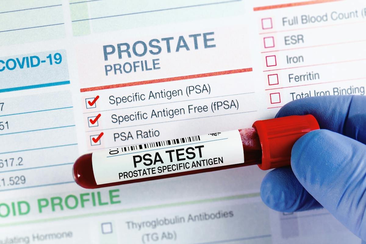 Blood sample tube placed beside a prostate laboratory report
